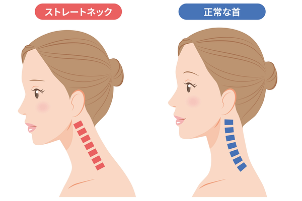 ストレートネックの症状の画像